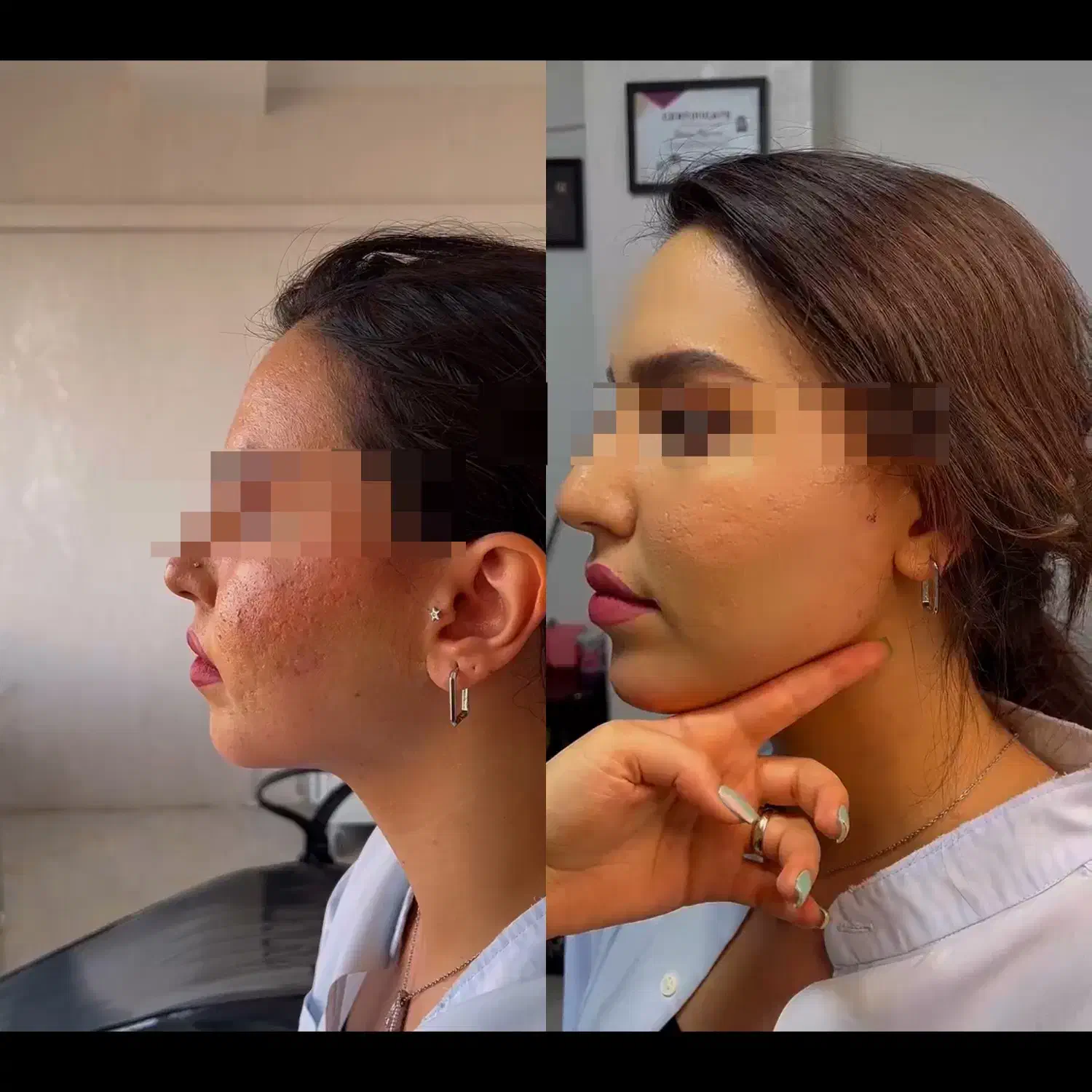 تزریق ژل و بوتاکس و مادلینگ عربی|خدمات آرایشگری و زیبایی|کرمانشاه, |دیوار