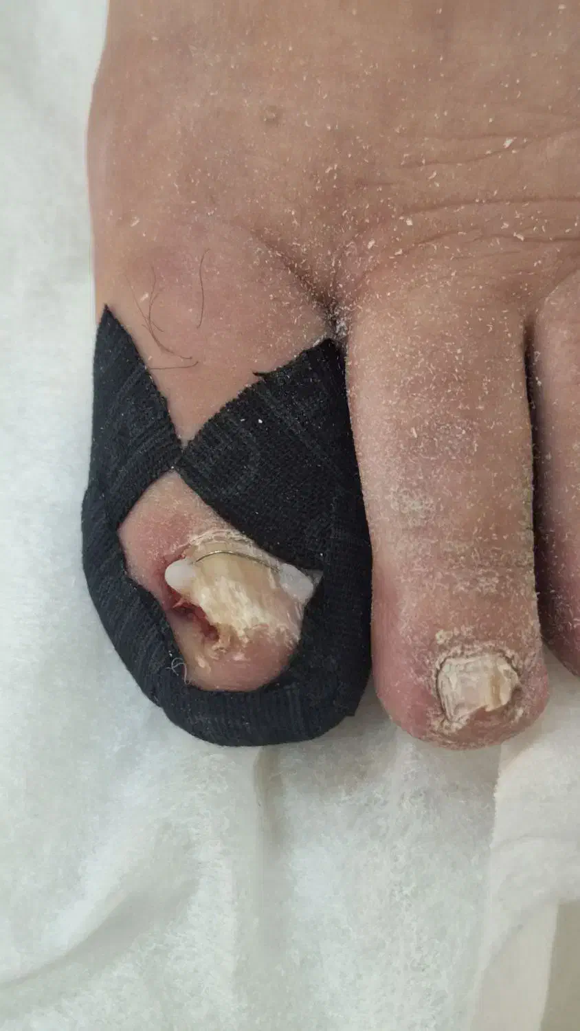 درمان ناخن تو گوشت رفته و قارچ گرفته|آرایشی، بهداشتی، درمانی|ارومیه, |دیوار