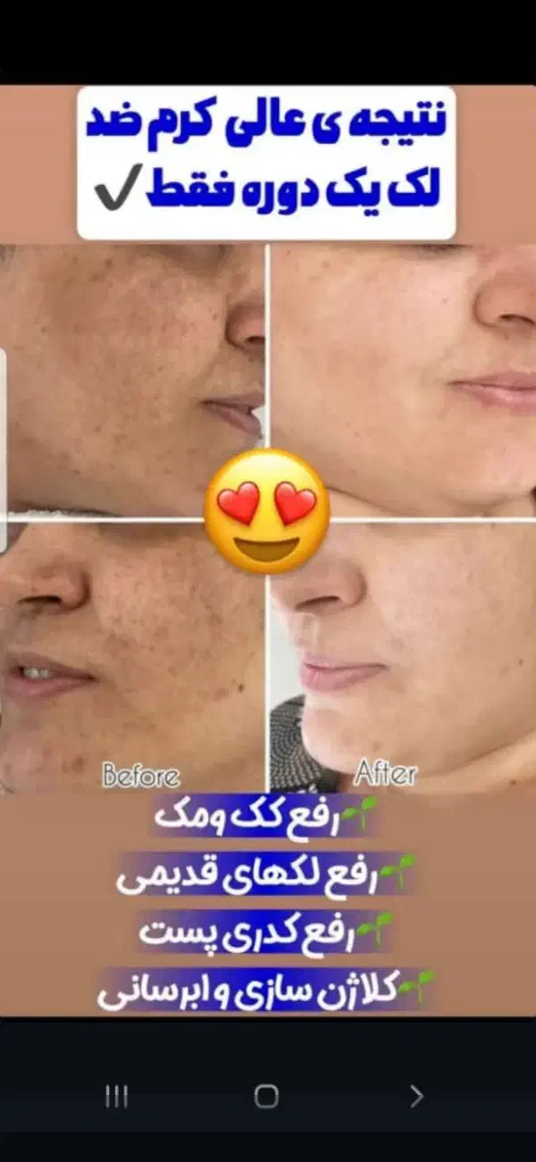 کرم vip بزرگ ضدلک و سفید کننده|آرایشی، بهداشتی، درمانی|گرگان, |دیوار