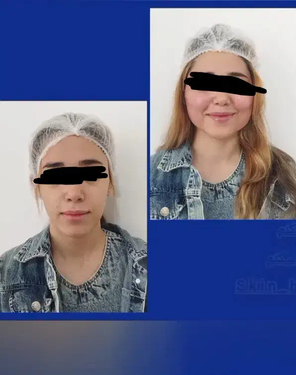 تزریق وتخلیه چربی جراحی پلک لابیا وغیره|خدمات آرایشگری و زیبایی|خرمآباد, |دیوار