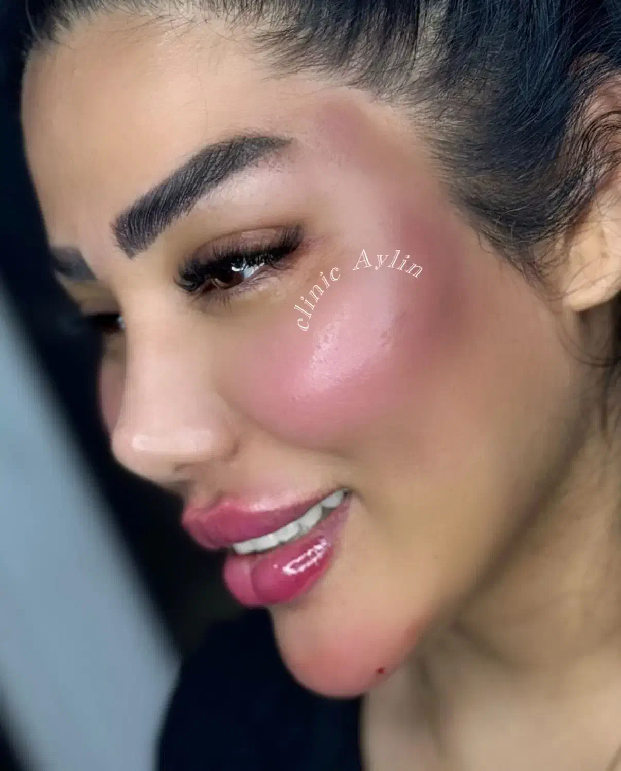 ژل لب فیلر بوتاکس مزو جوانسازی کانتوریگ لیفت نخ|خدمات آرایشگری و زیبایی|تهران, پونک|دیوار