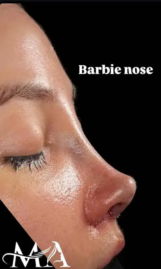 جشنواره جراحی و عمل بینی در کرج|خدمات آرایشگری و زیبایی|چهارباغ, |دیوار