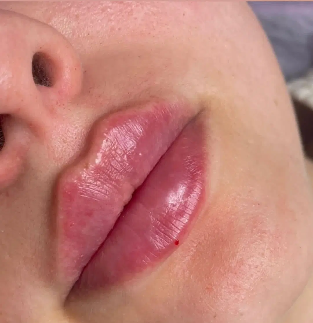 جشنواره ژل و فیلر لب/گونه/زاویه چانه800 در مطب|خدمات زیبایی و سلامت|اصفهان, شاهزید|دیوار