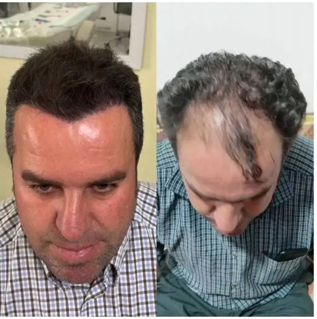 کاشت مو/کاشت ریش/کاشت ابرو اقساط*ی در اصفهان|خدمات آرایشگری و زیبایی|فولادشهر, فولادشهر|دیوار