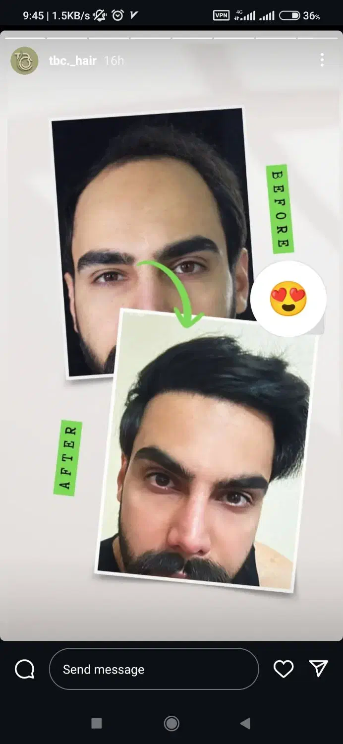 کاشت مو بصورت کاملاً تخصصی|خدمات آرایشگری و زیبایی|پاکدشت, پاکدشت (مامازند)|دیوار