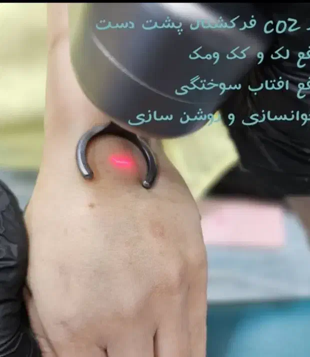 لیپوساکشن،غبغب،لیزرco2|خدمات آرایشگری و زیبایی|شیراز, تلخ داش|دیوار