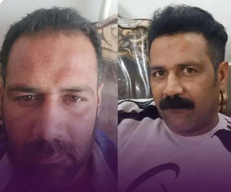 کاشت مو فول تراکم با ضمانت در شیراز|خدمات آرایشگری و زیبایی|لردگان, |دیوار