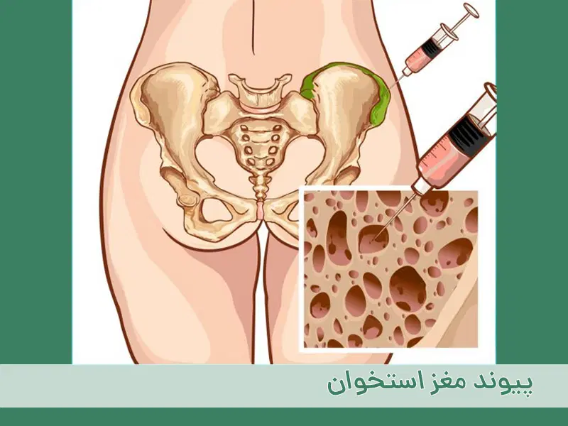 تجربه پیوند مغز استخوان اتولوگ بیمارستان شریعتی|فعالیت داوطلبانه|تهران, فاطمی|دیوار