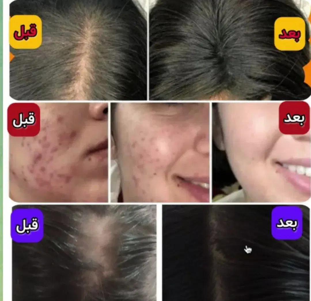 پوستت روزیباترکن|خدمات آرایشگری و زیبایی|مهران (هرمزگان), |دیوار