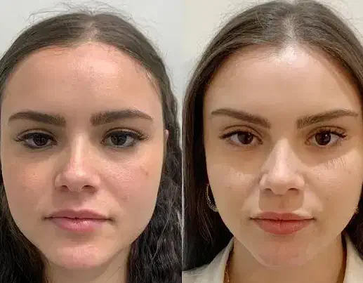 تخفیف پاییزی بوتاکس کلینیک زیبایی|خدمات آرایشگری و زیبایی|اردبیل, |دیوار