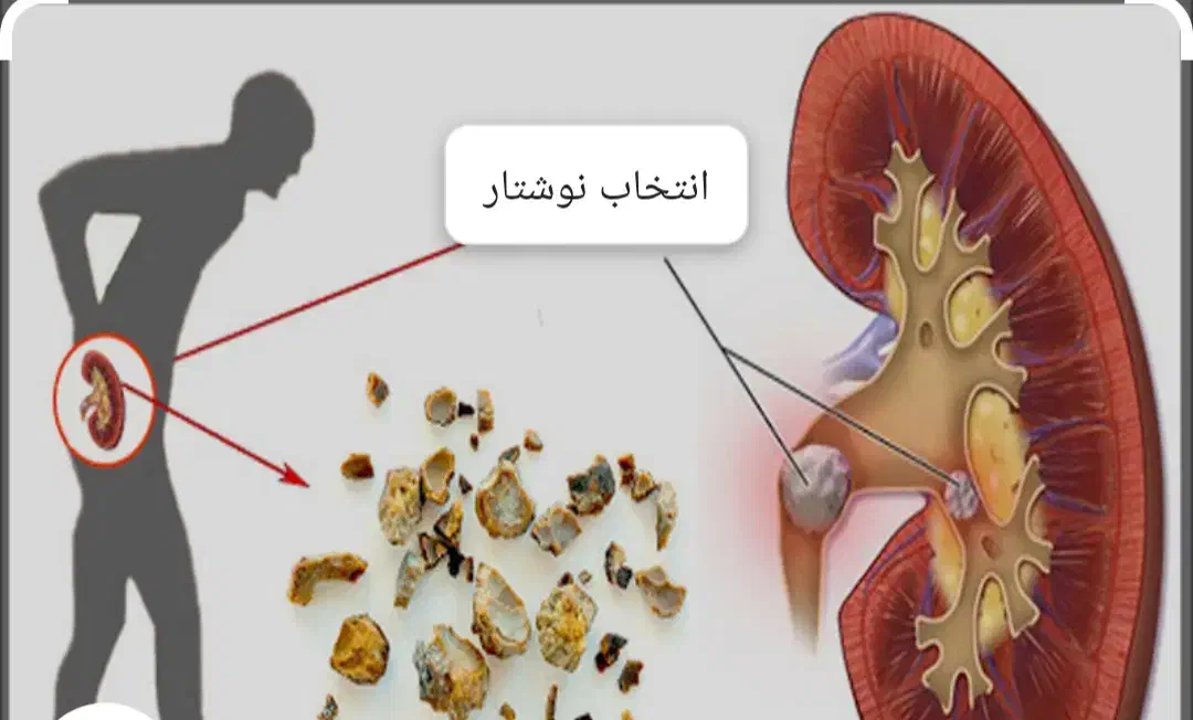 راه نمایی برای از بین بردن سنگ کلیه|فعالیت داوطلبانه تحقیقاتی|اهواز, کوروش|دیوار