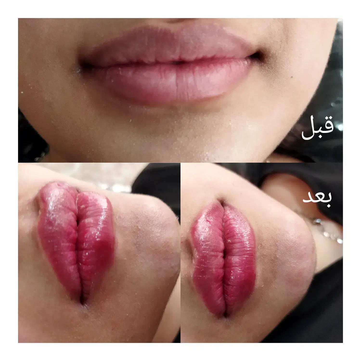 ژل وبوتاکس|خدمات آرایشگری و زیبایی|قم, شهرک فاطمیه|دیوار