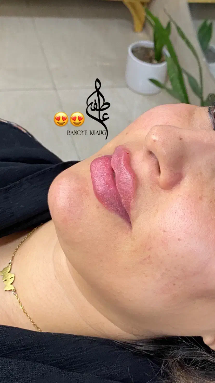 خدمات فیلر و بوتاکس|خدمات آرایشگری و زیبایی|خرمشهر, |دیوار