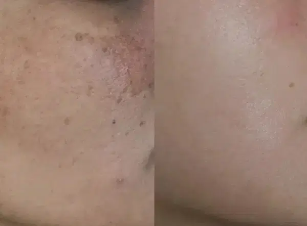 پی آرپی prp مزوتراپی مزونیدلینگ بوتاکس فشیال آنزیم|خدمات زیبایی و سلامت|تهران, دردشت|دیوار