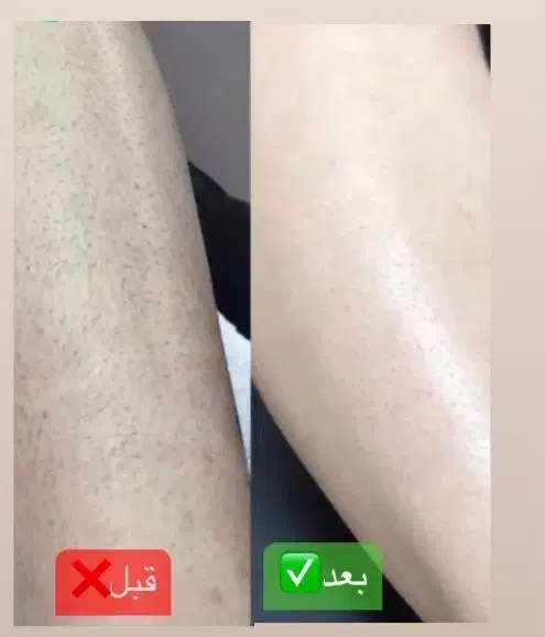 لیزر موهای زائد|خدمات آرایشگری و زیبایی|شیراز, شهرک قمشه|دیوار