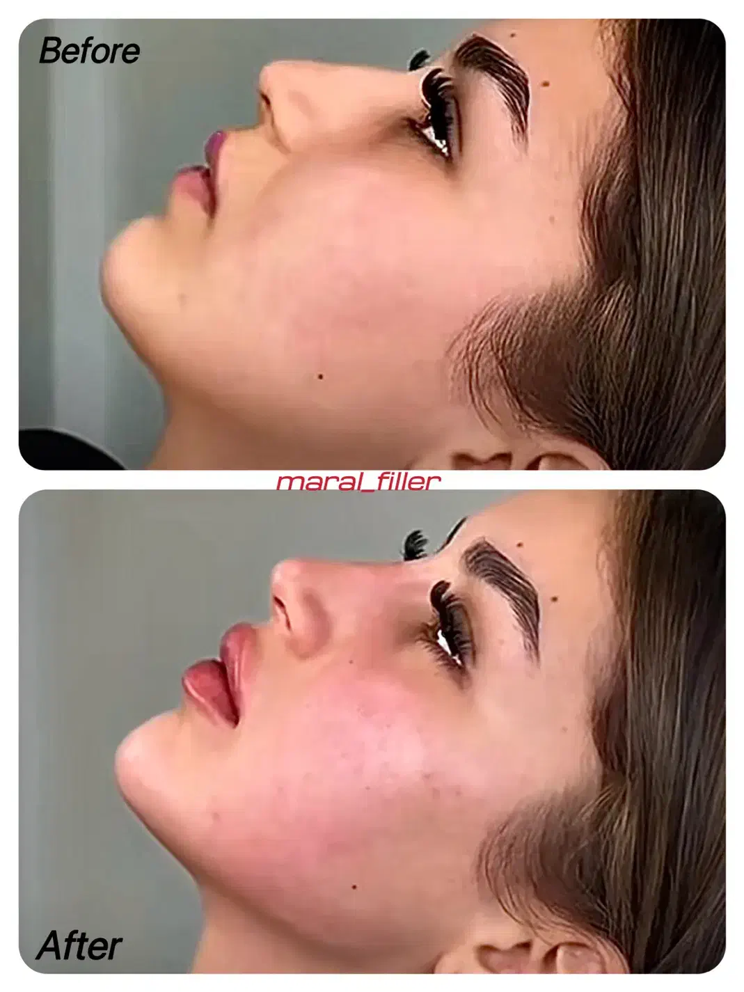 تزریق ژل و بوتاکس|خدمات آرایشگری و زیبایی|اهواز, کوروش|دیوار