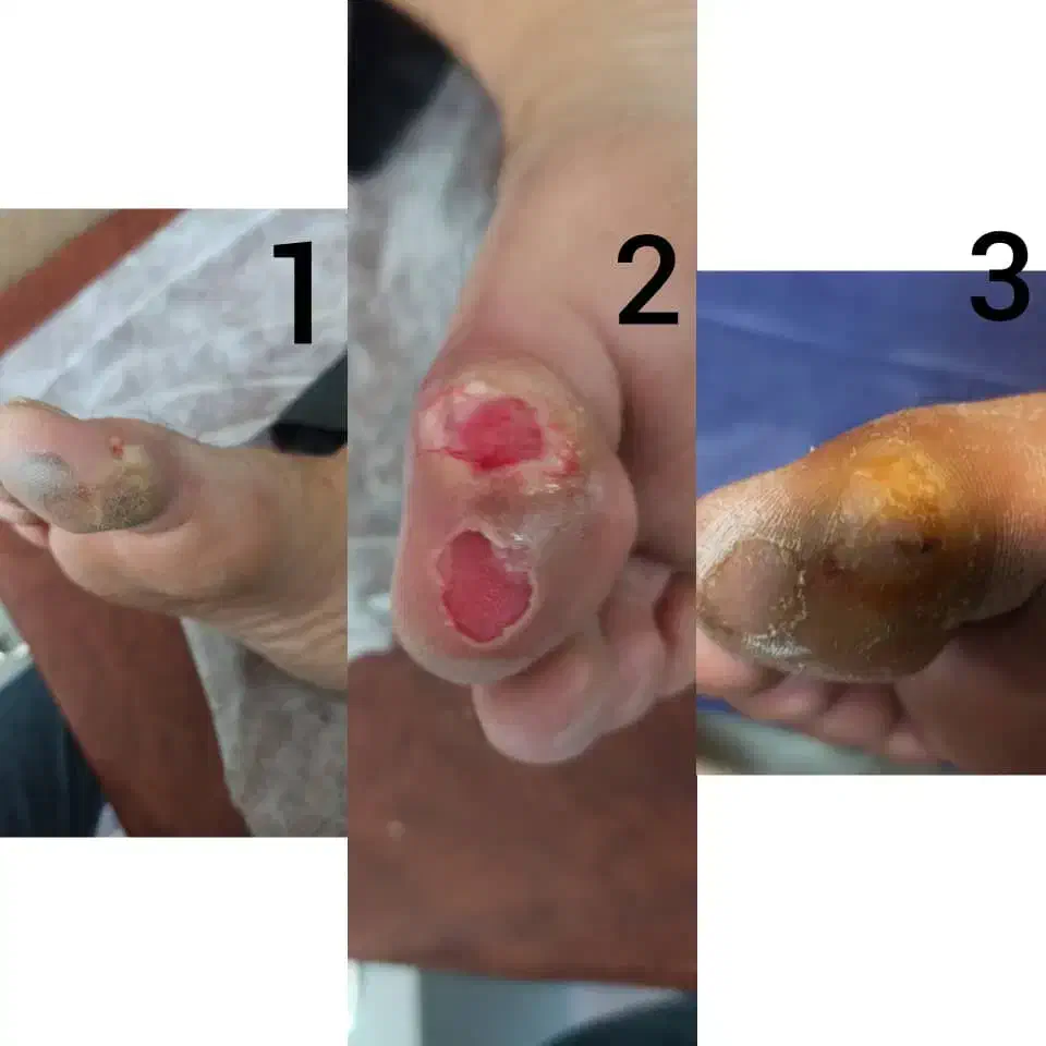 درمان تضمینی و تخصصی زخم در منزل|خدمات آرایشگری و زیبایی|تهران, نظامی گنجوی (توانیر)|دیوار