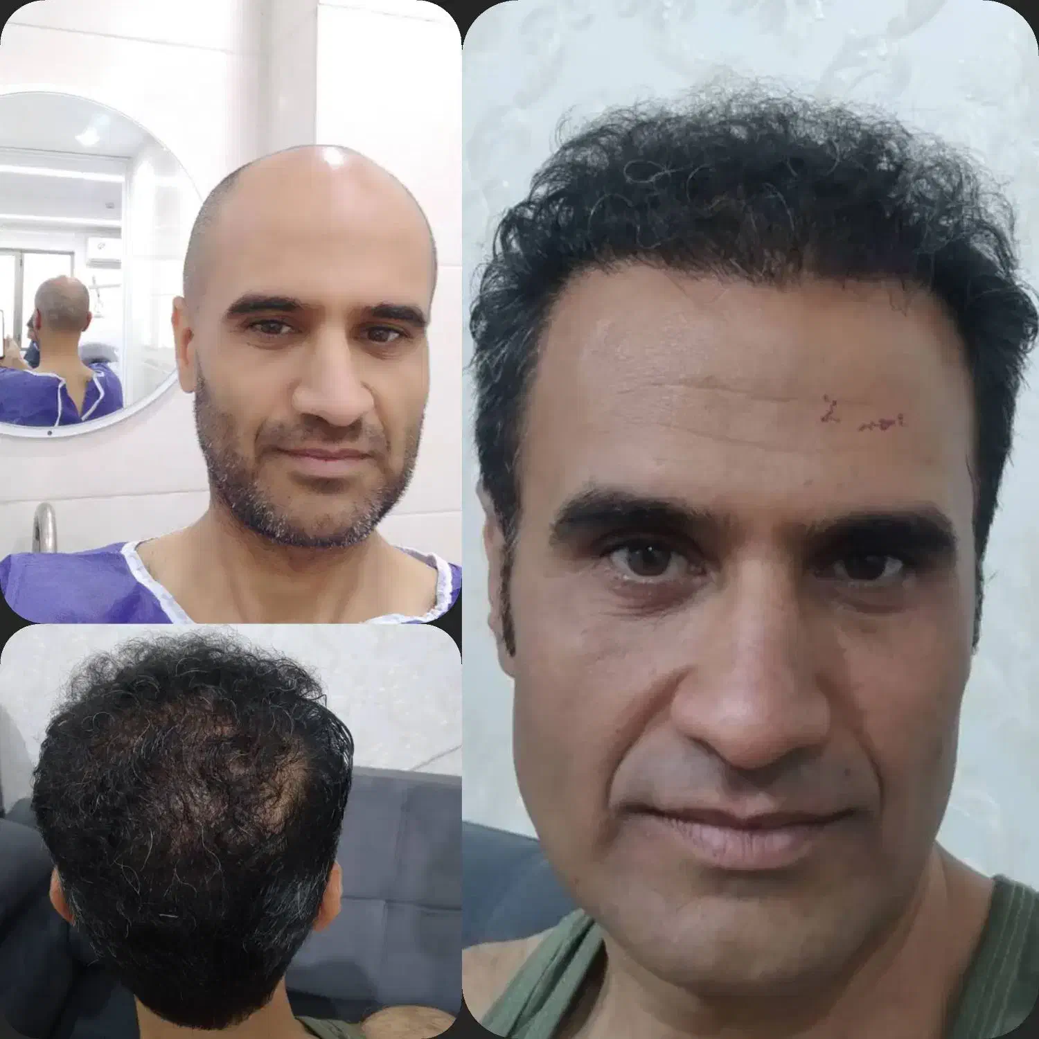 کاشت مو وابرو جشنواره ویژه|خدمات آرایشگری و زیبایی|یزد, |دیوار