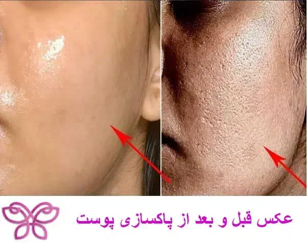 آف پاکسازی پوست صورت|خدمات آرایشگری و زیبایی|مسجد سلیمان, |دیوار