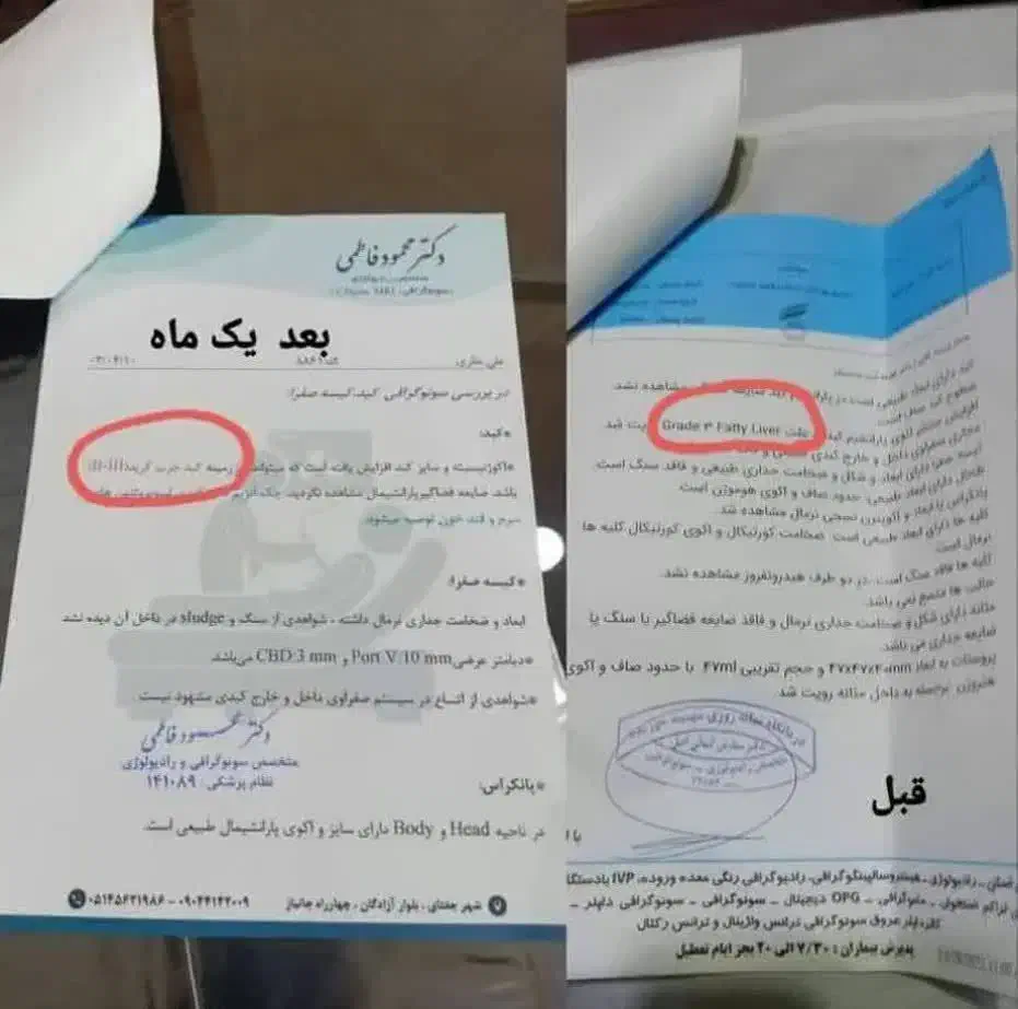 درمان قطعی کبدچرب|آرایشی، بهداشتی، درمانی|آمل, |دیوار