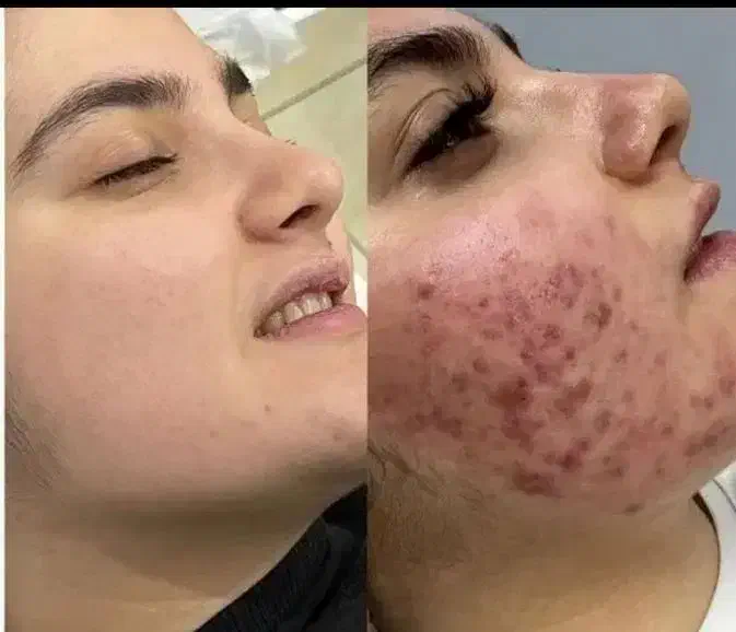 جشنوار یلدا درمان تضمینی کک ومک/لک/خال/فقط در1جلسه|خدمات آرایشگری و زیبایی|اصفهان, باغ زیار|دیوار