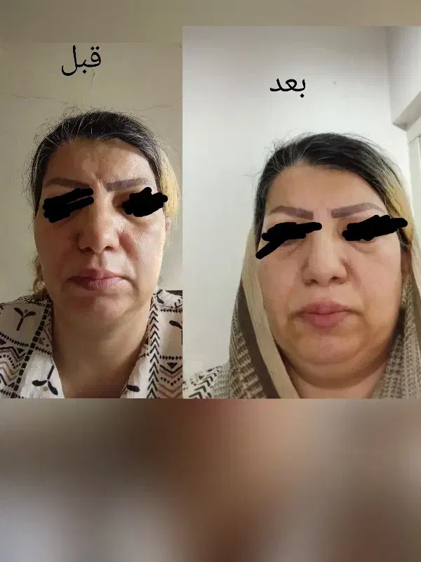 جوش لک و چین چروک امانت بریده|آرایشی، بهداشتی، درمانی|اهواز, آریاشهر|دیوار