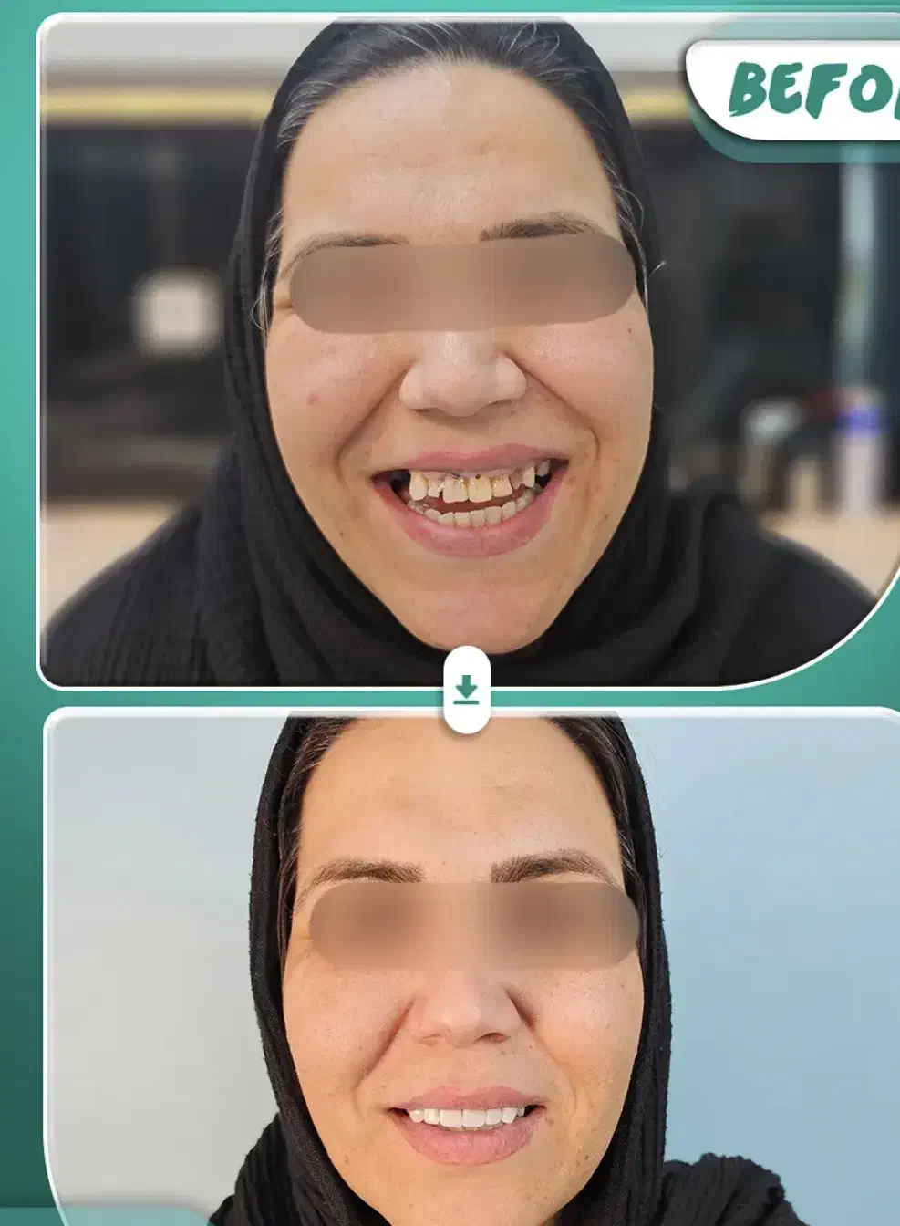 ایمپلنت بلندمدت/کامپوزیت/لمینت/درمانی|خدمات آرایشگری و زیبایی|مرند, |دیوار