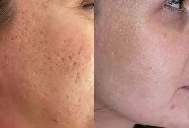 برداشتن خال وزگیل جوانسازی پاک کردن تاتو صورت وبدن|خدمات زیبایی و سلامت|کرمانشاه, |دیوار