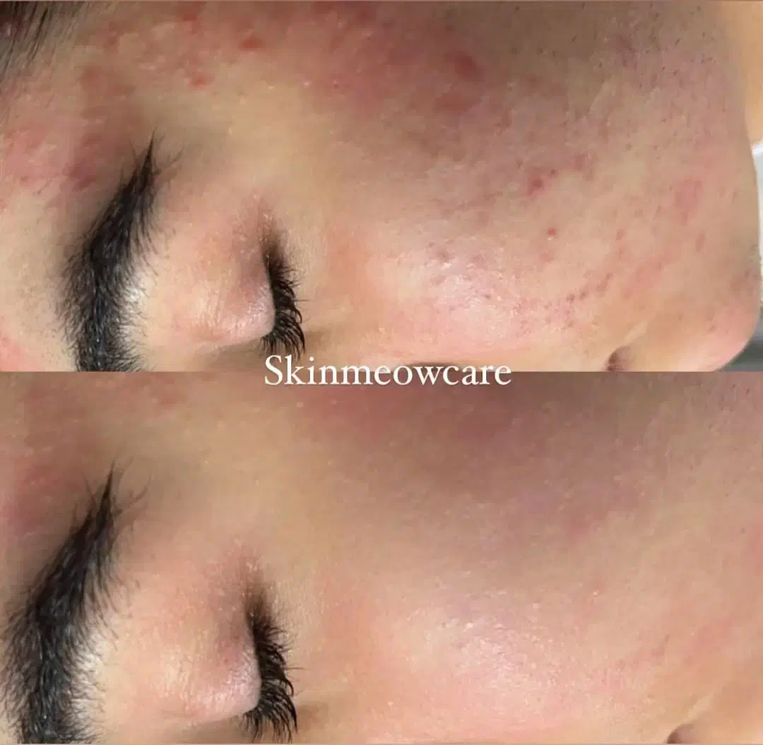 مدل پاکسازی صورت و فیشیال فوری فقط هزینه مواد|خدمات آرایشگری و زیبایی|اهواز, پردیس دو|دیوار