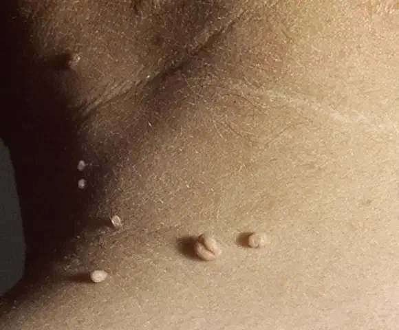 خال برداری برداشت زگیل زگیل تناسلی خال اسکین تک|خدمات آرایشگری و زیبایی|مشهد, سیلو|دیوار