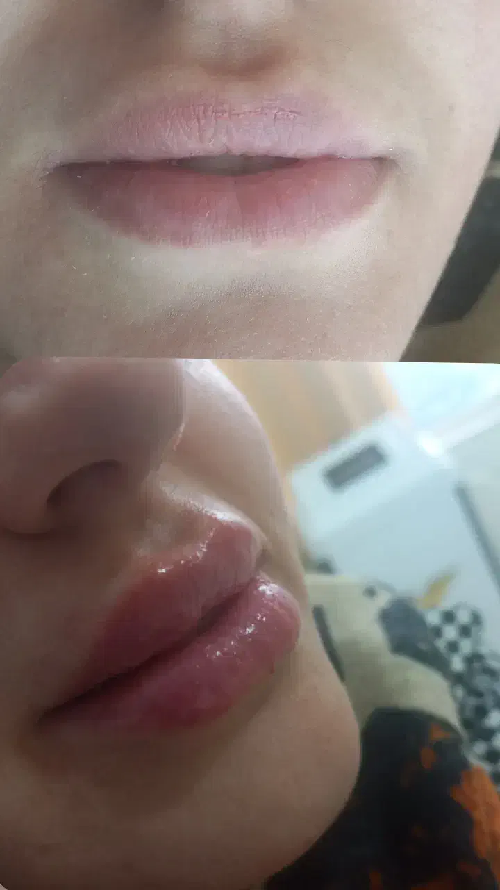 لیزر ژل وبوتاکس وخالبرداری سم زدایی|خدمات آرایشگری و زیبایی|تبریز, |دیوار