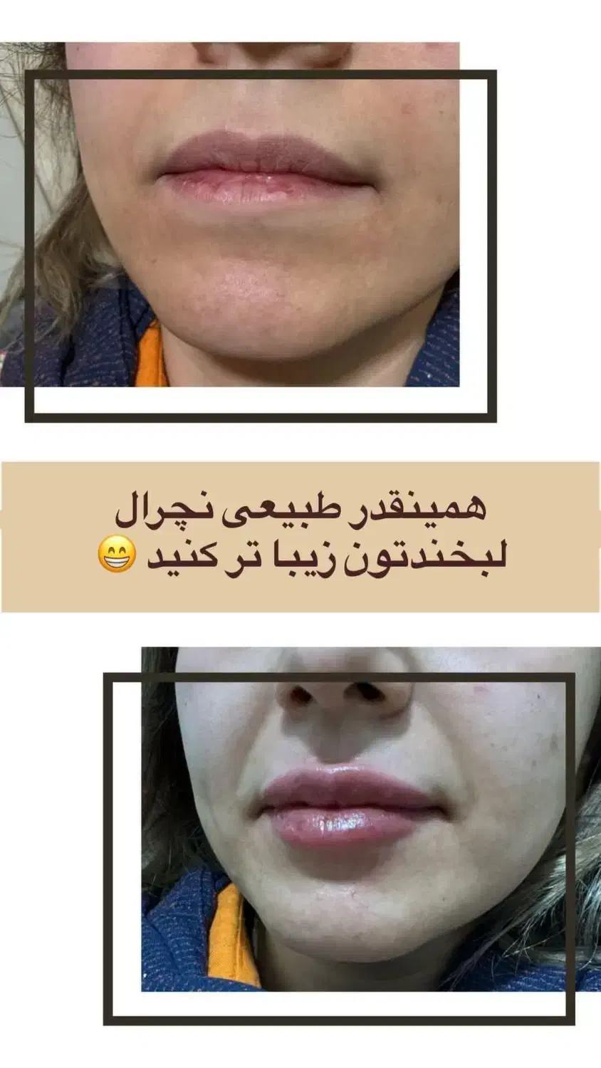 مطب زیبایی در کرمان با ضمانت صد در صد بوتاکس|خدمات آرایشگری و زیبایی|کرمان, |دیوار