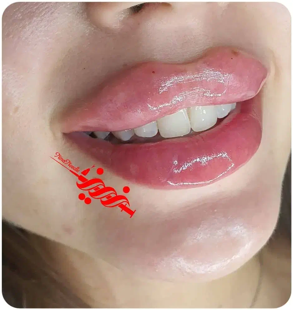 تزریق فیلر ژل و بوتاکس در کلینیک|خدمات آرایشگری و زیبایی|بندرعباس, |دیوار