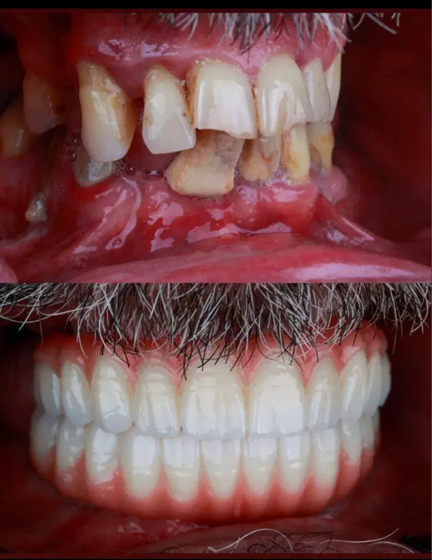 ایمپلنت با اقساط بلند مدت در تبریز|خدمات آرایشگری و زیبایی|اهر, |دیوار