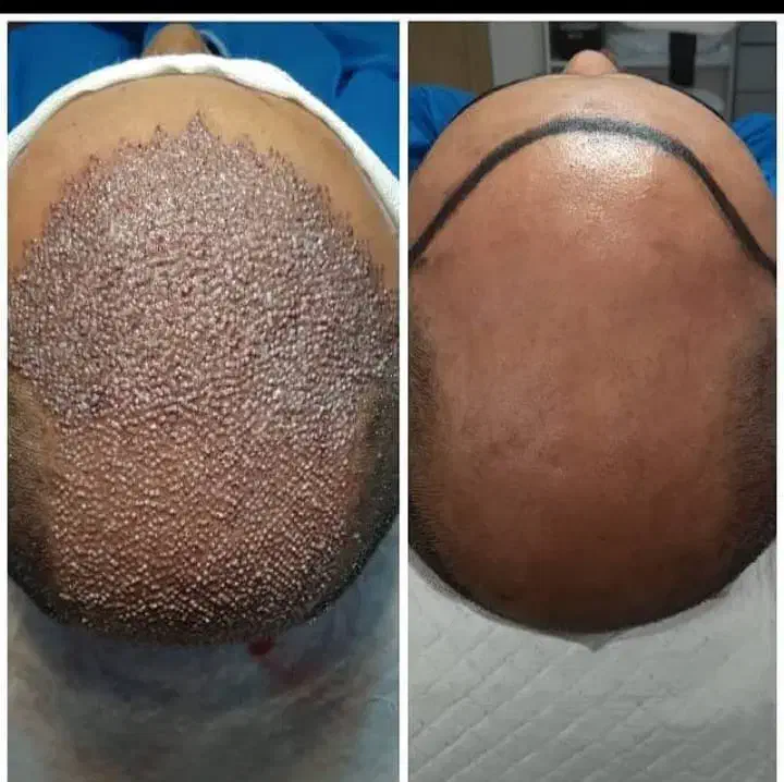 کاشت موی طبیعی -بازگشت اعتماد بنفس شما در یک جلسه|خدمات آرایشگری و زیبایی|یزد, |دیوار