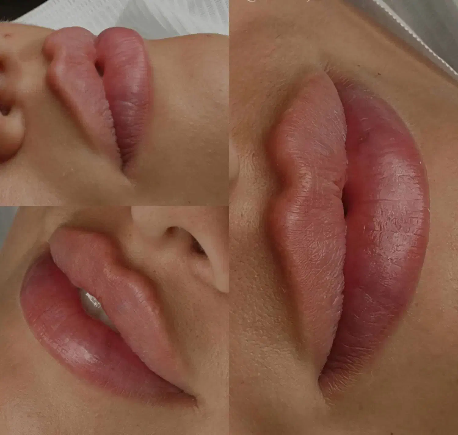 تزریق فیلر و بوتاکس و مزوتراپی لیزر|خدمات آرایشگری و زیبایی|هشتگرد, هشتگرد قدیم|دیوار