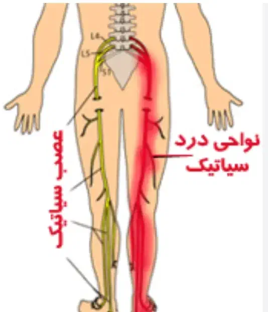 درمان درد سیاتیک و دیسک کمر|آرایشی، بهداشتی، درمانی|هامون, |دیوار