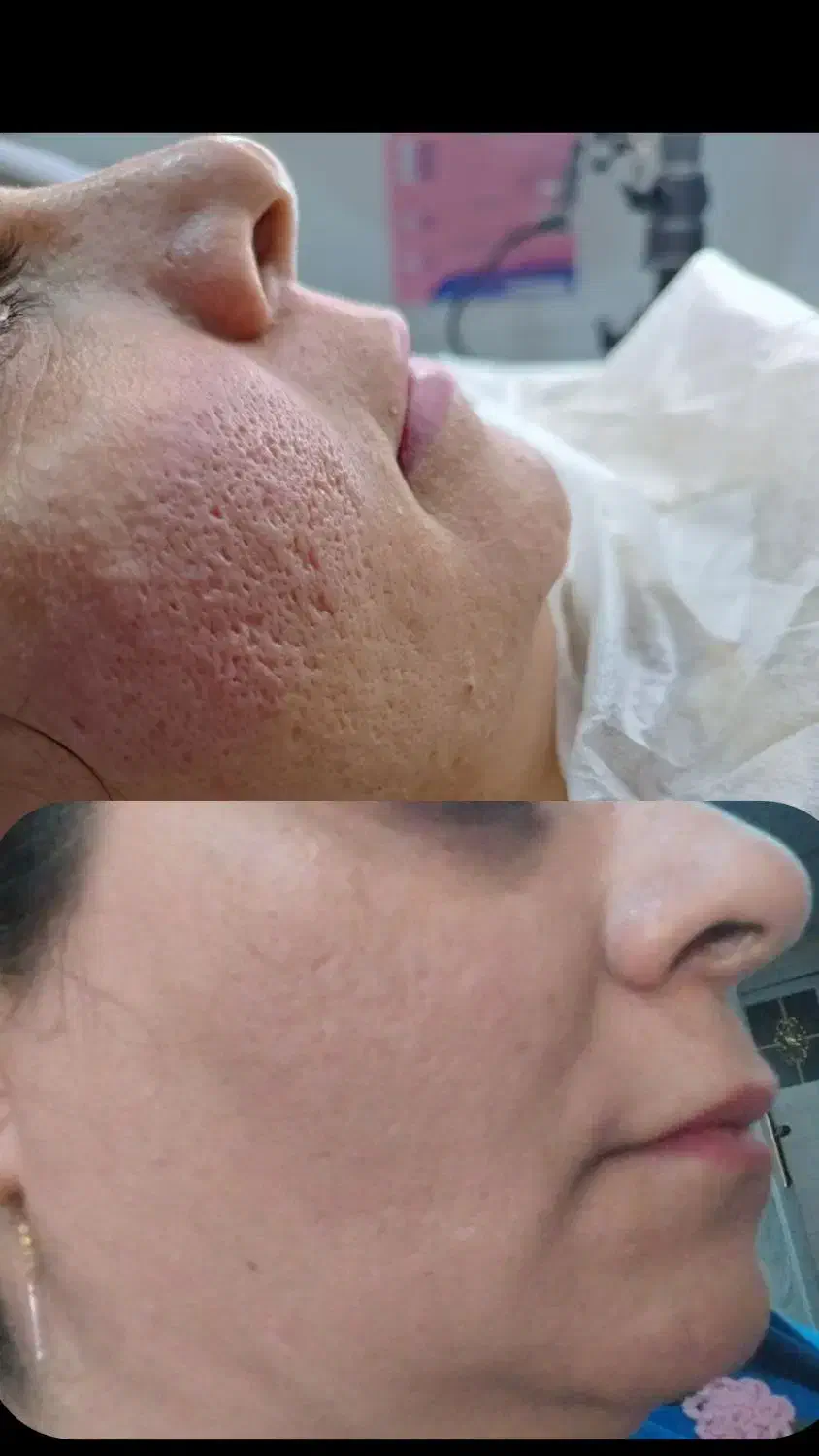 فیشیال درمانی تک جلسه ای|خدمات آرایشگری و زیبایی|مشهد, کشف|دیوار