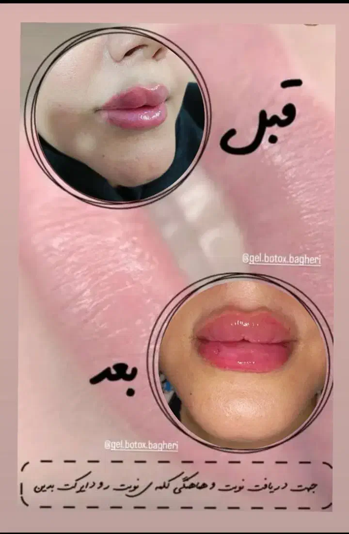 تزریق ژل و بوتاکس|خدمات آرایشگری و زیبایی|قم, مهدیه|دیوار