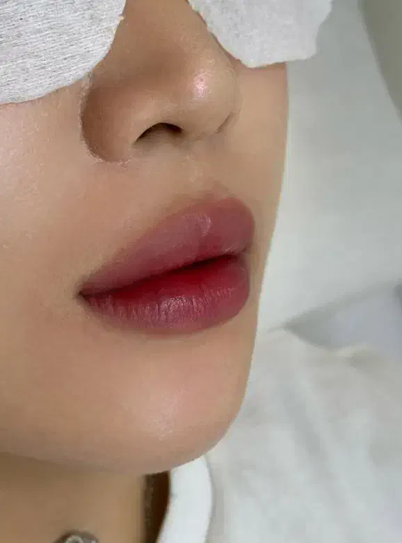 ژل و بوتاکس صورت|خدمات آرایشگری و زیبایی|فولادشهر, مسکن مهر فولادشهر|دیوار