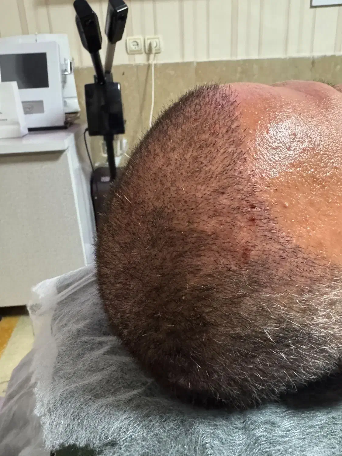 مزوتراپی مو (قطع ریزش)|خدمات آرایشگری و زیبایی|اندیشه, اندیشه فاز ۳|دیوار