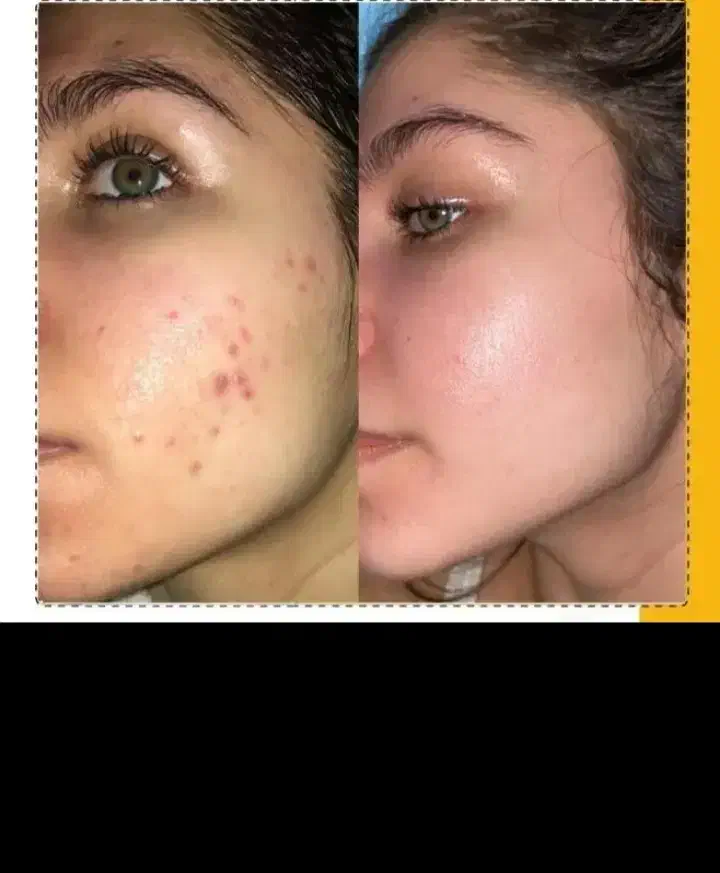 ژل گیاهی جوانسازی ضدلک ضدجوش ضدکک مک|آرایشی، بهداشتی، درمانی|بروجرد, |دیوار