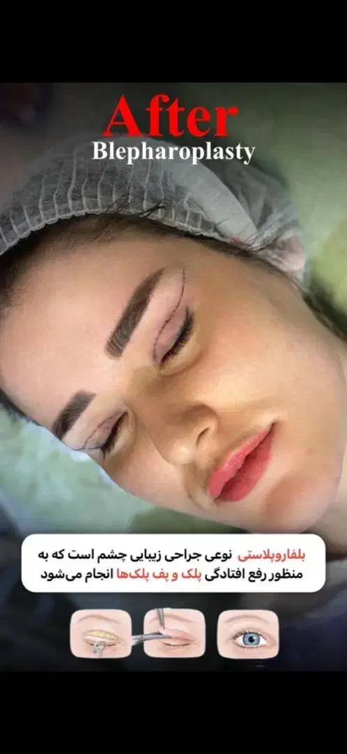 جراحی بلفاروپلاستی|خدمات آرایشگری و زیبایی|تهران, هفت حوض|دیوار