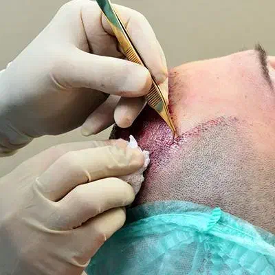 آموزش تخصصی کاشت مو|خدمات آموزشی|شیراز, معالیآباد|دیوار