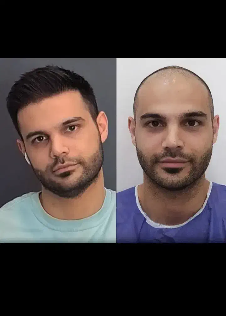 اقساطی کاشت مو تضمینی/کاشت ابرو کاشت|خدمات آرایشگری و زیبایی|تهران, چیذر|دیوار