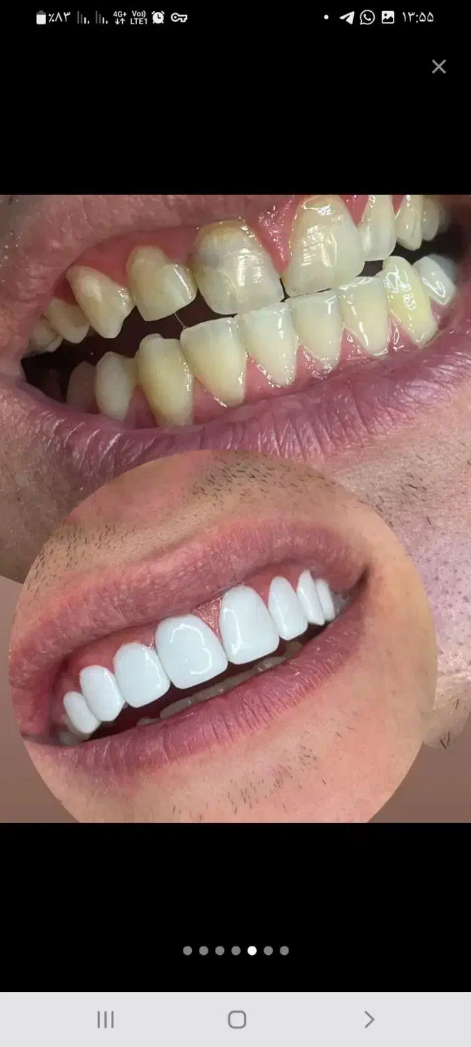 جشنواره کامپوزیت دندان|خدمات آرایشگری و زیبایی|شاهرود, |دیوار