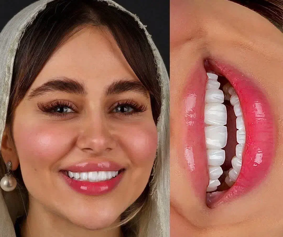 ایمپلنت اقساطی دندانپزشکی لمینیت|خدمات آرایشگری و زیبایی|کیش, |دیوار