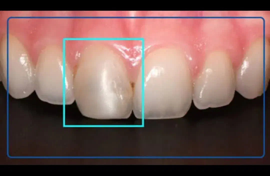 عصبکشی اندو دندان جلو۱۲۳تعرفه دولتی|خدمات آرایشگری و زیبایی|قم, زنبیل آباد|دیوار