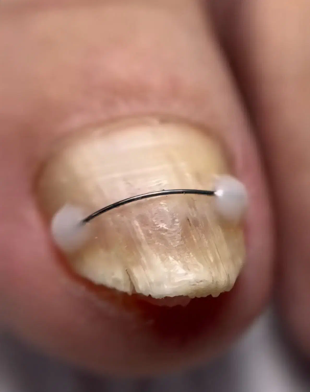 درمان و اصلاح ناخن پا در کلینیک لوتس و منزل|خدمات آرایشگری و زیبایی|تهران, یوسف‌آباد|دیوار