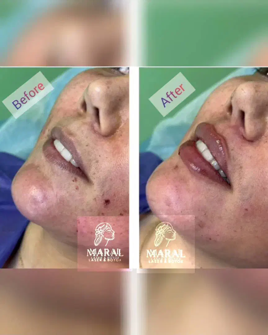 تخفیفات ویژه لیزر فیلر بوتاکس خالبرداری فیشال|خدمات آرایشگری و زیبایی|تهران, یافت آباد شمالی|دیوار